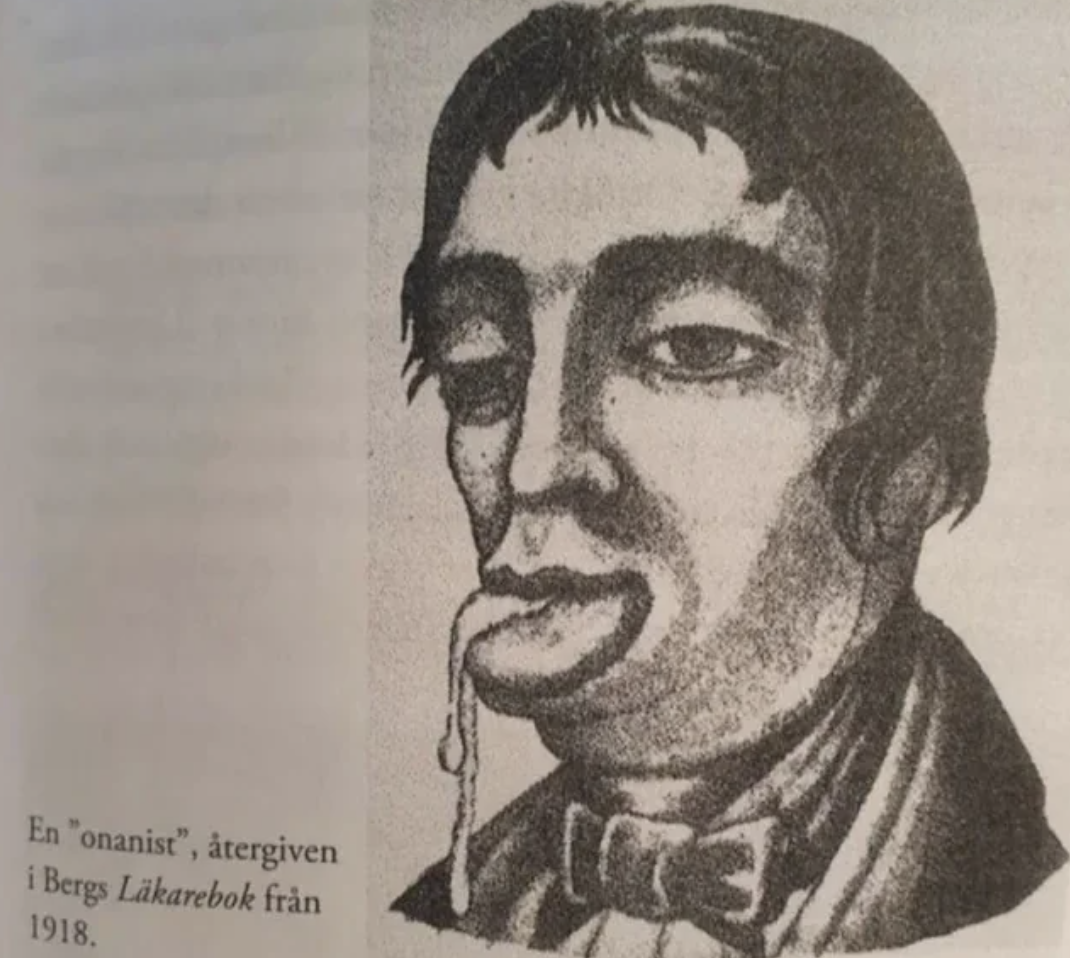 Illustration of a person with drool, captioned in Swedish detailing that it is from a 1918 medical book by Berg