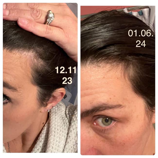 Side-by-side comparison of reviewer's hairline before and after using after one month showing more hair at the temples