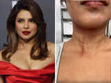 Priyanka Chopra health update: Actor suffers throat injury while shooting a Hollywood movie