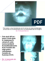 Foto Waters: Sinus Frontalis Dex-Sin N, Sinmax Sin TMPK Prselubungan, Sinmax Dex N, Sin Ethmoid Dex-Sin N, Sin Spenoidalis Dex-Sin N, tlg2 N