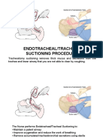 Endotracheal Suctioning Procedure