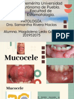 Mucocele 