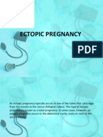 Ectopic Pregnancy