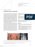 Calcinosis Cutis Universalis: Clinicalpicture