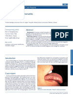 Cinnamon Contact Stomatitis