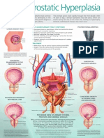 Benign Prostatic Hyperplasia: Sagittal View of Lower Urinary Tract
