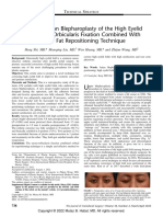 Revisional Asian Blepharoplasty of The High Eyelid Fold - Tarsus-Orbicularis Fixation Combined With Orbital Fat Repositioning Technique