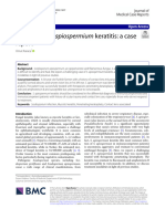 Scedosporium Apiospermium Keratitis: A Case: Case Report Open Access