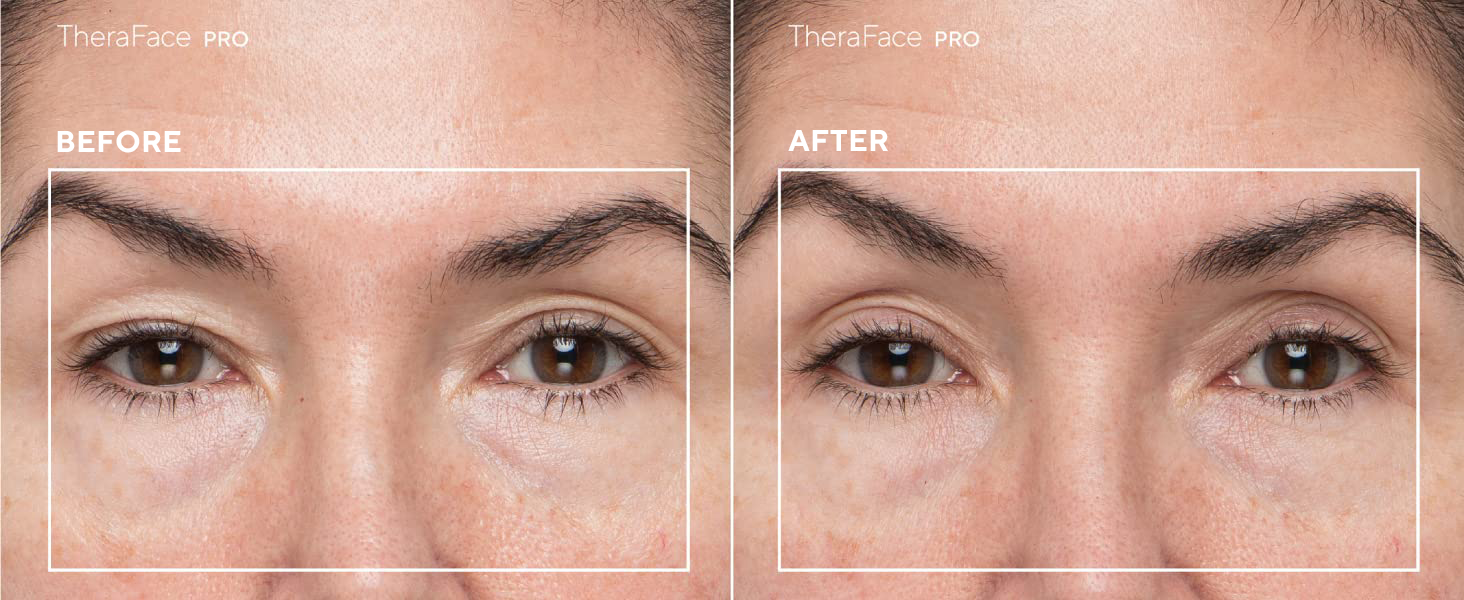 Clinical Study with Text upper eyes lifted Therface pro treatment