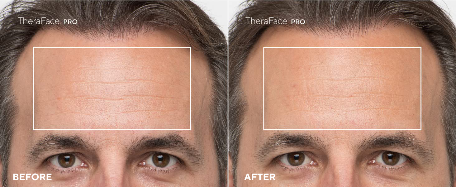 Clinical Study 3 theraface pro wrinkle wrinkles reduction fine lines 