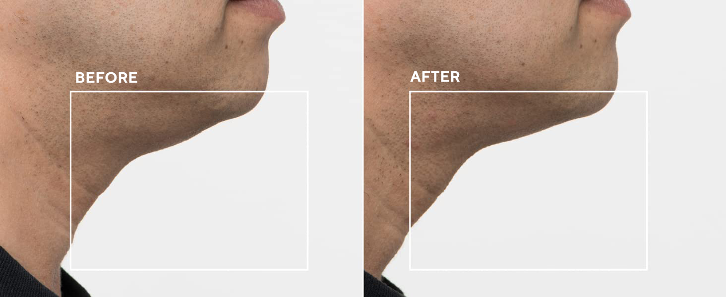 Clinical Study 4 contoured neck improved appearance jaw line 