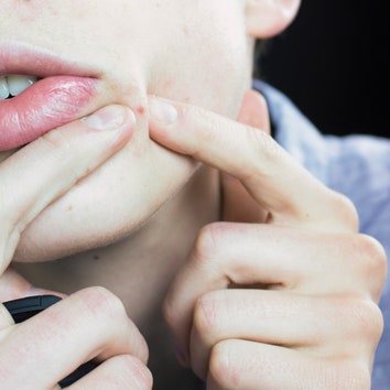 There Is Nothing More Satisfying Than Watching This Four-Year-Old Zit Being Slowly Popped