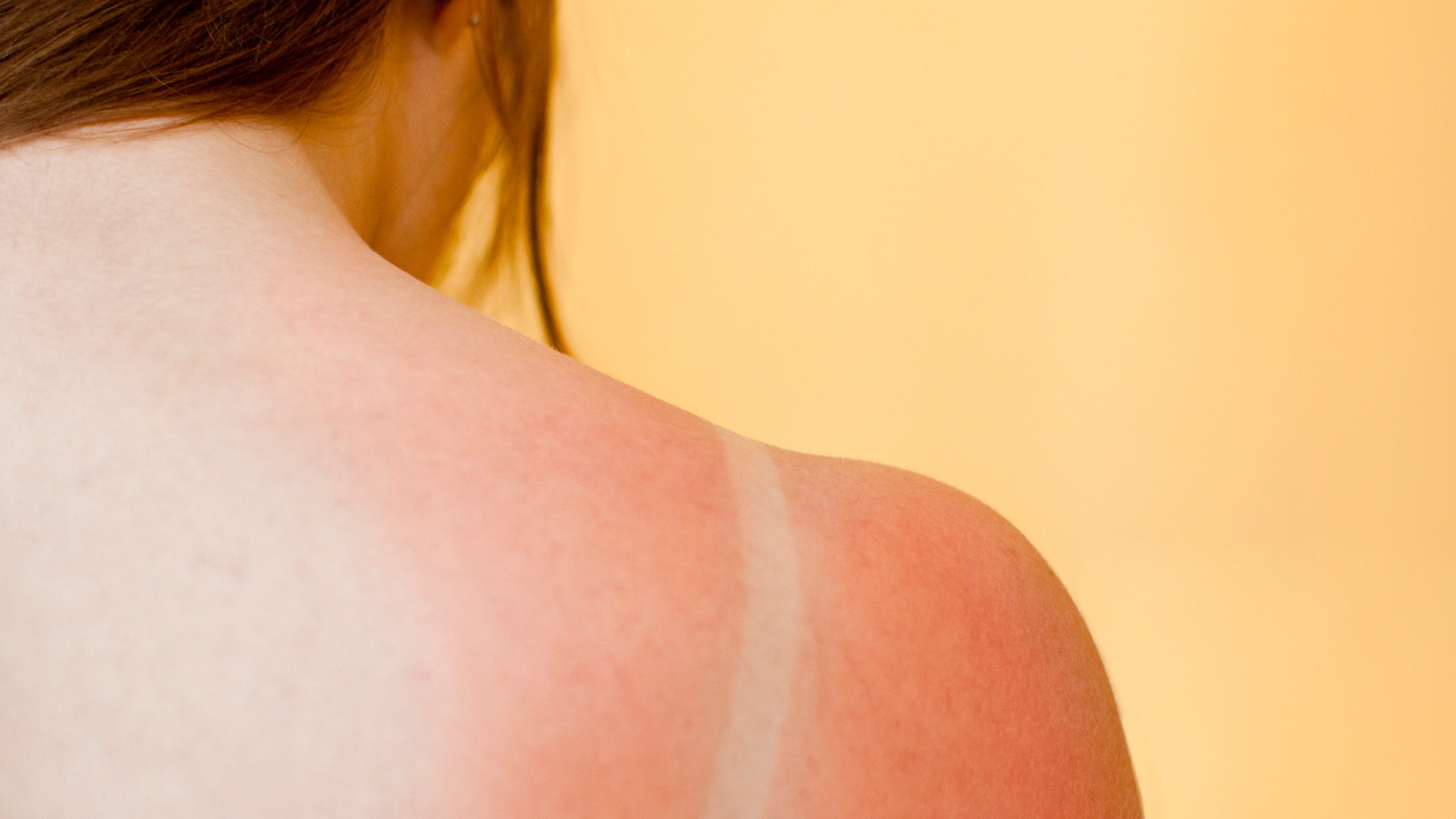 Woman with sunburned shoulders