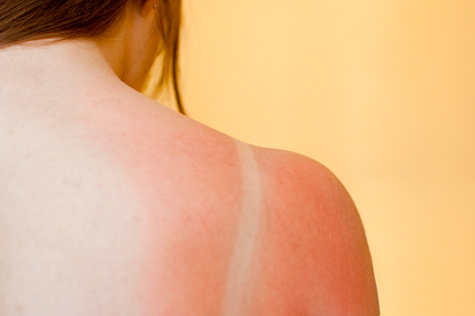 Woman with sunburned shoulders
