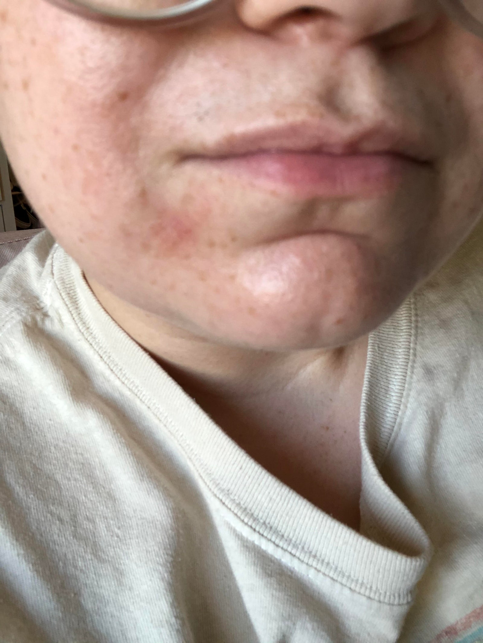 woman with rash around her mouth