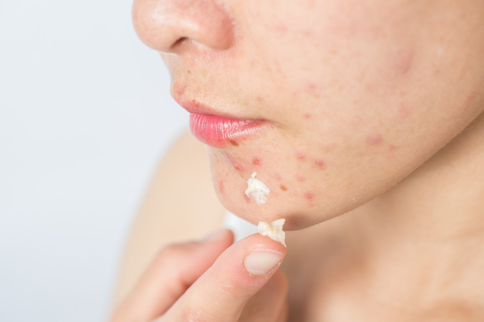 person putting spot treatment on acne blemishes