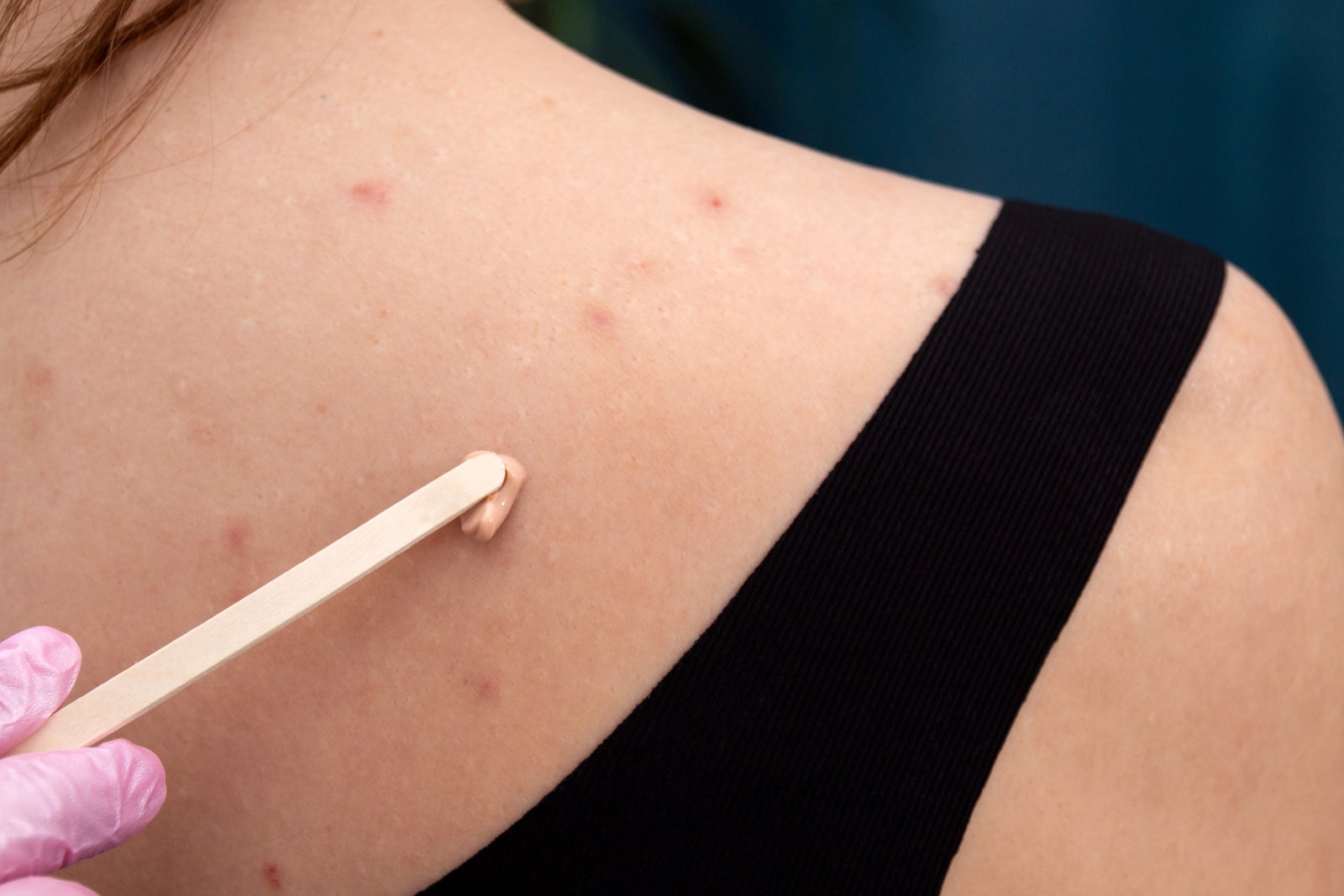 Applying a cream mask against acne on a woman's back with a wooden stick. Beauty treatment.