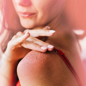 Your Sunburn Is Peeling &- Now What?