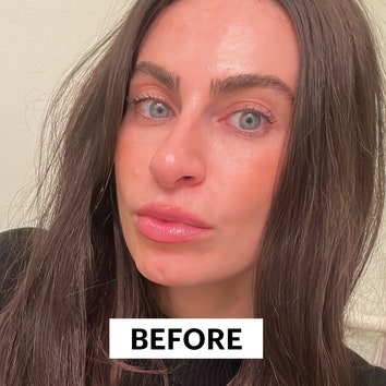 I Used Filler to Get Rid of My Cleft Chin