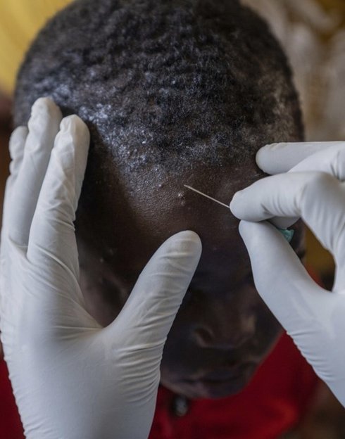 A health care provider examines a child for signs of mpox. Children are at high risk during the Mpox outbreak in North Kivu, where the disease has claimed many young lives. Photo: PATH/Moses Sawasa.