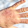 Eczema treatment lebrikizumab