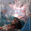 Brain tumor craniotomy violinist