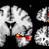 Brain scans depression