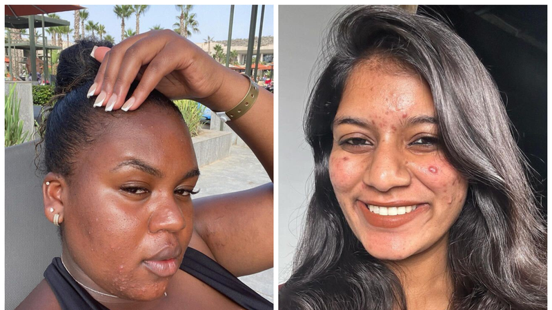 Just 12 People Proudly Sharing Unfiltered, Makeup-Free Pics of Their Acne