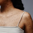 Dermatologists Breakdown Body Acne Causes and Treatments