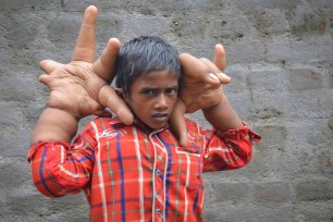 Eight-year-old Kaleem shows his abnormally large hands in his hometown, East India.