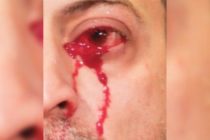 The man's eyes started bleeding because he had non-cancerous tumors underneath his eyelids.