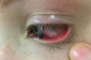 The pencil lead shown impaled in the student's left eye.