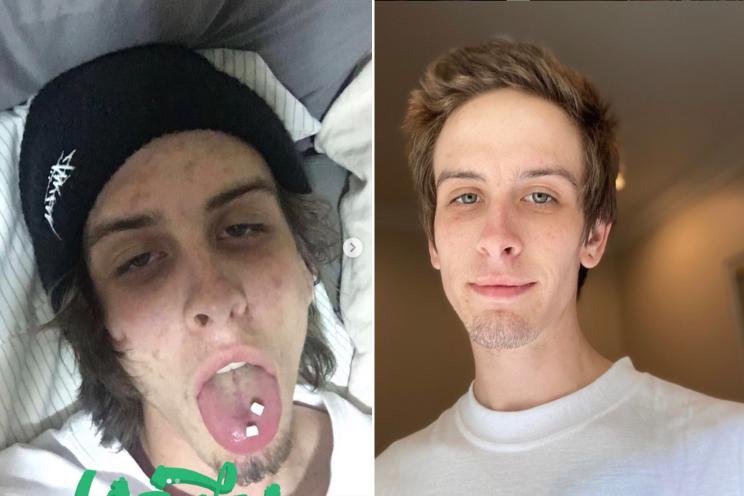 Travis Robinson shared before and after pictures to document his recovery from drug addiction.