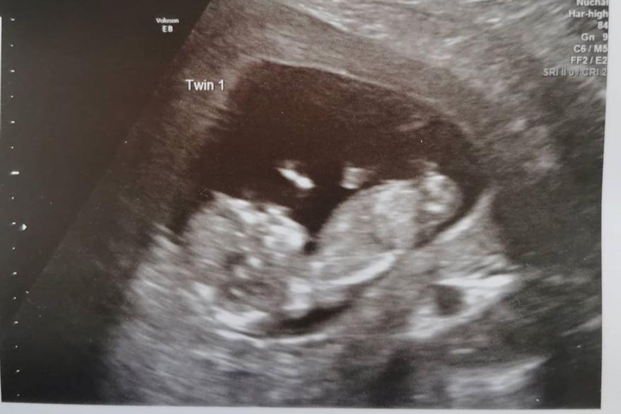 Kelly Fairhurst discovered she was expecting twins during a scan, and that each twin was developing in a separate womb.