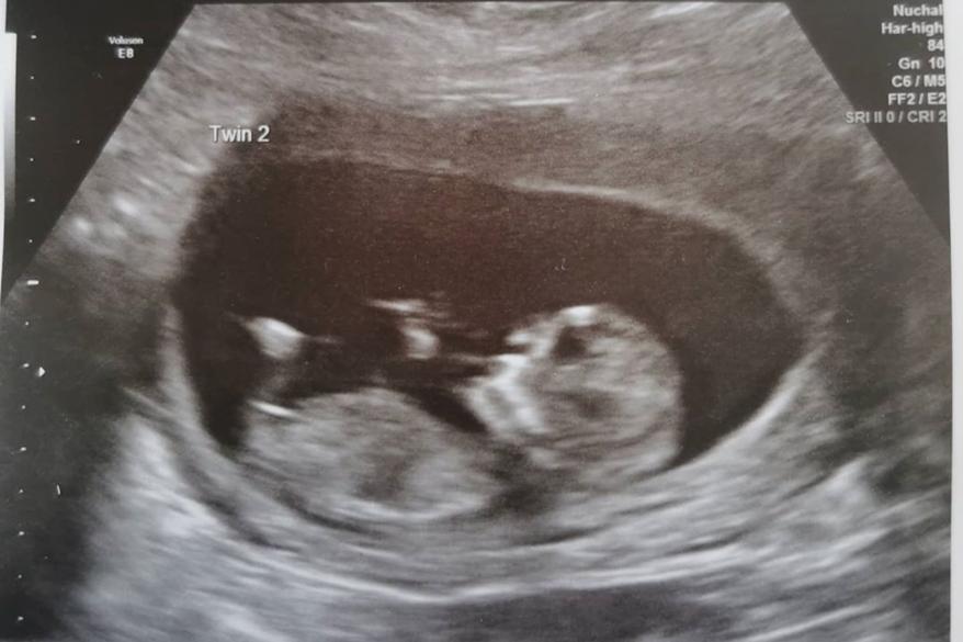 Kelly Fairhurst discovered she was expecting twins during a scan, and that each twin was developing in a separate womb.