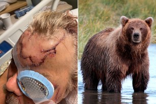 This May 18, 2021 photo provided by Allen Minish shows lacerations on Minish's head as he recuperates at a hospital in Anchorage, Alaska, following a mauling by a brown bear.