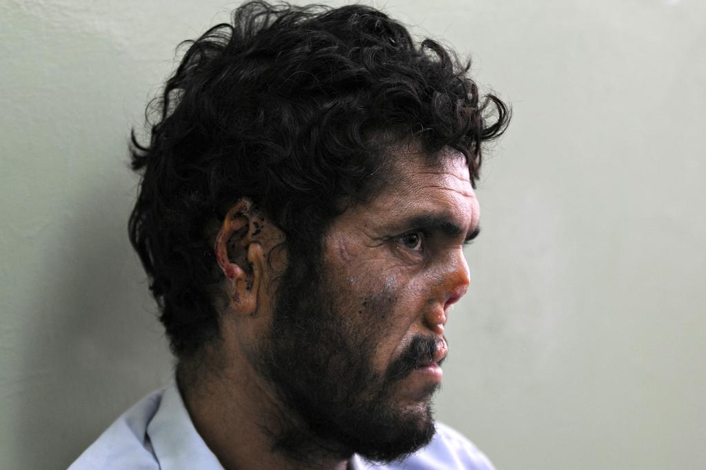 In 2009, Afghan farmer Lal Mohammad said his nose and ears were cut of by the Taliban.