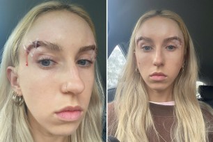 Hannah Edwards, 25, 'wanted to die" after undergoing the excruciatingly painful fox eye lift procedure.