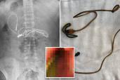 A boy in Turkey baffled doctors when they found a charging cable in his stomach.