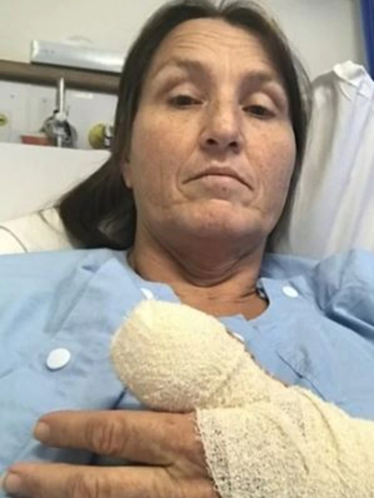 The woman, who goes by Sue spent five days in the hospital after discovering that a chunk of her thumb bone would need to be removed.