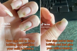 Fungal infection on nail
