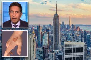 NYC is home to the first known cases of antifungal-resistant ringworm in the US, according to a report published Thursday by the Centers for Disease Control and Prevention.