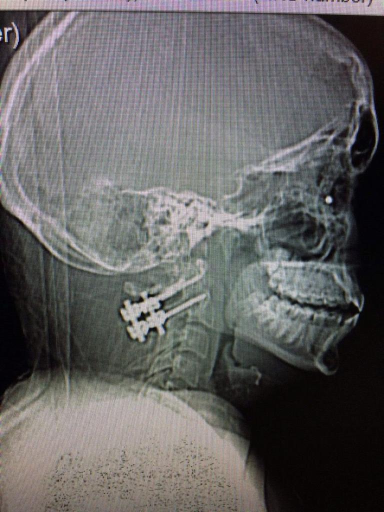 Edby had fractured her neck in three places.