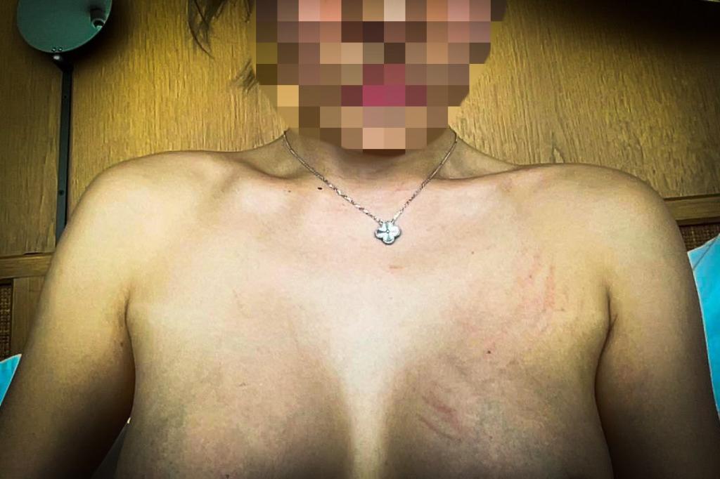 Xu's shared photos of her bruises 