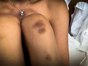 Xu's shared photos of bruises on her knees