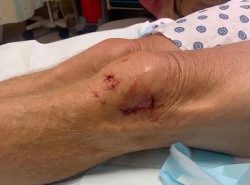 Matt Leffers' leg seen with puncture wounds from the otter attack  