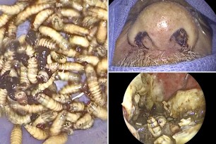 Jacksonville doctors removed 150 live bugs in the larva stage from the nose and sinuses of a cancer survivor earlier this month, First Coast News reports.