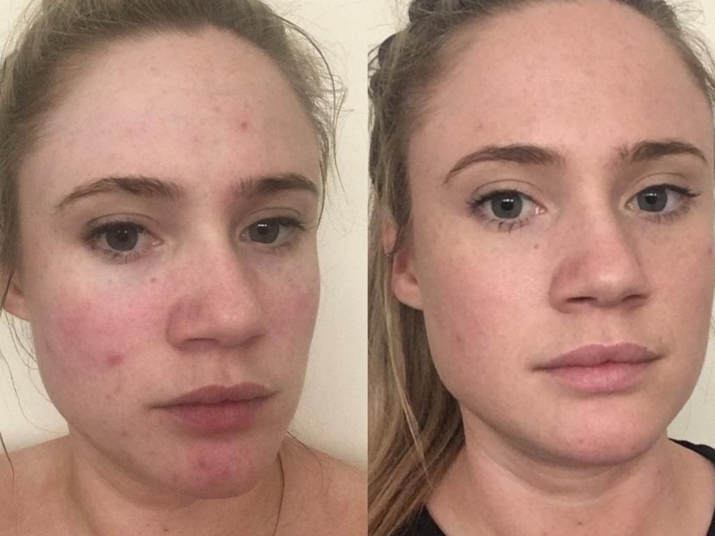 Kayla’s skin at age 27 (left), then three months after using Tribe Skincare (right). 