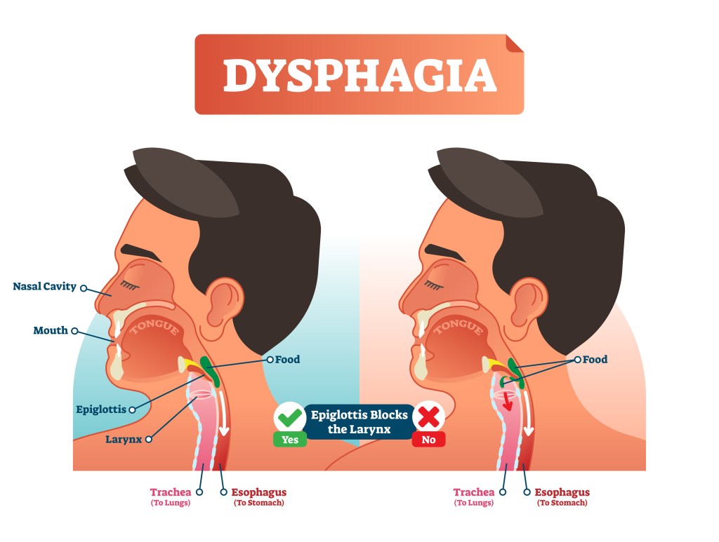 An illustration of dysphagia is shown, one of the symptoms that can show in people with dementia.