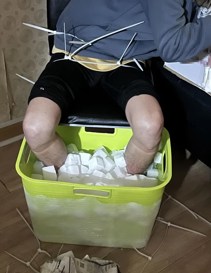 A 24-year-old man soaked his legs in dry ice and later had them amputated.